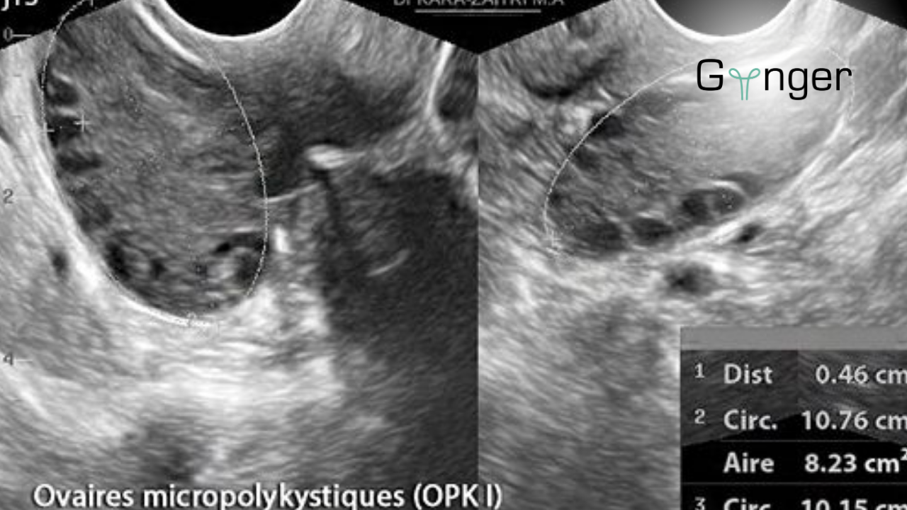 Thumbnail for: OPK ou SOPK : ne confonds plus ces deux diagnostics